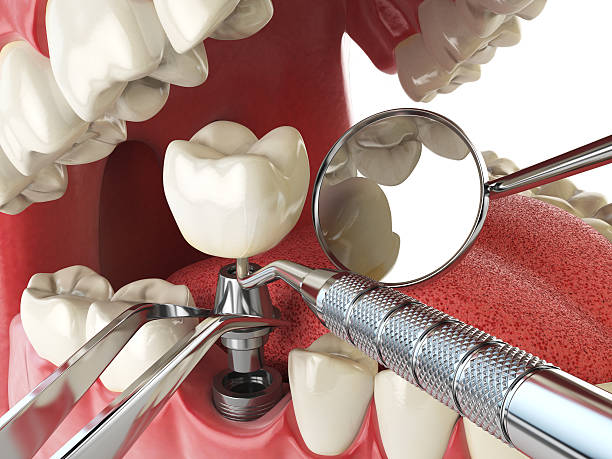 Best Emergency Root Canal Treatment in University, MS